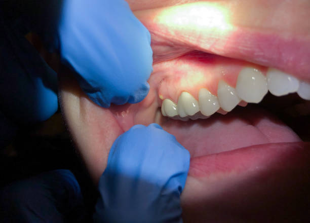 Best Emergency Wisdom Teeth Removal in Pittsfield, MA
